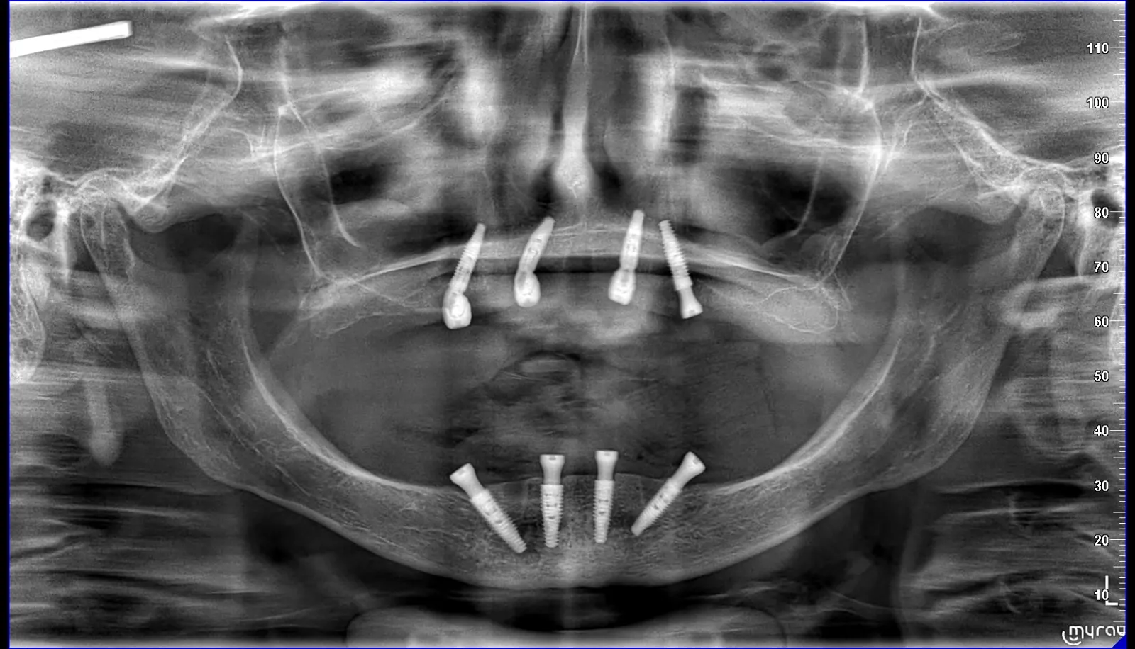 All on 4 Dental Implants
